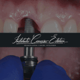 5 maiores dúvidas sobre implante dentário